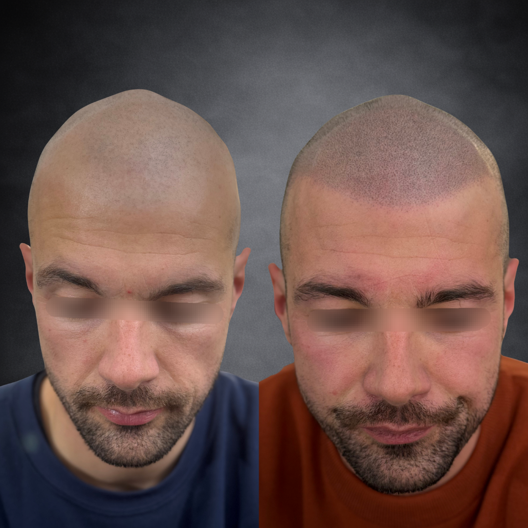 Avant / Après — Ligne frontale & reconstruction complète du vertex