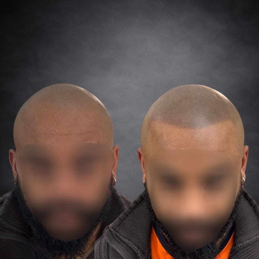Avant / Après — Ligne frontale & scalp
