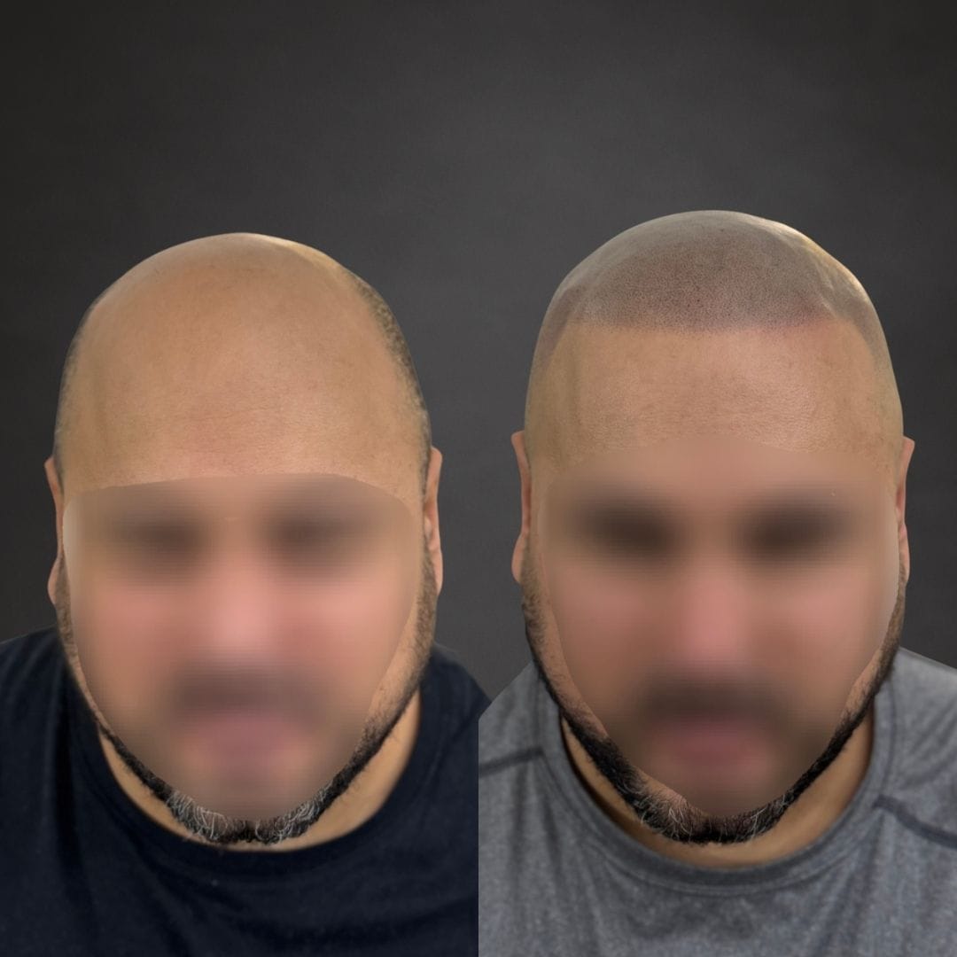 Avant / Après — Effet crane rasé
