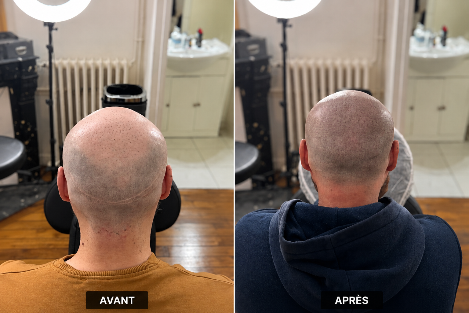 Témoignage tricopigmentation : deux greffes ratés, des cicatrices, une reconstruction